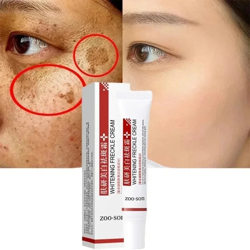 Whitening Freckle Cream – Dark Spot & Pigmentation Remover (20g)